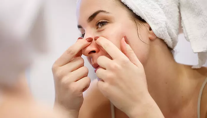 فشار دادن جوش ها از بدترین کار برای یک هفته قبل از عروسی